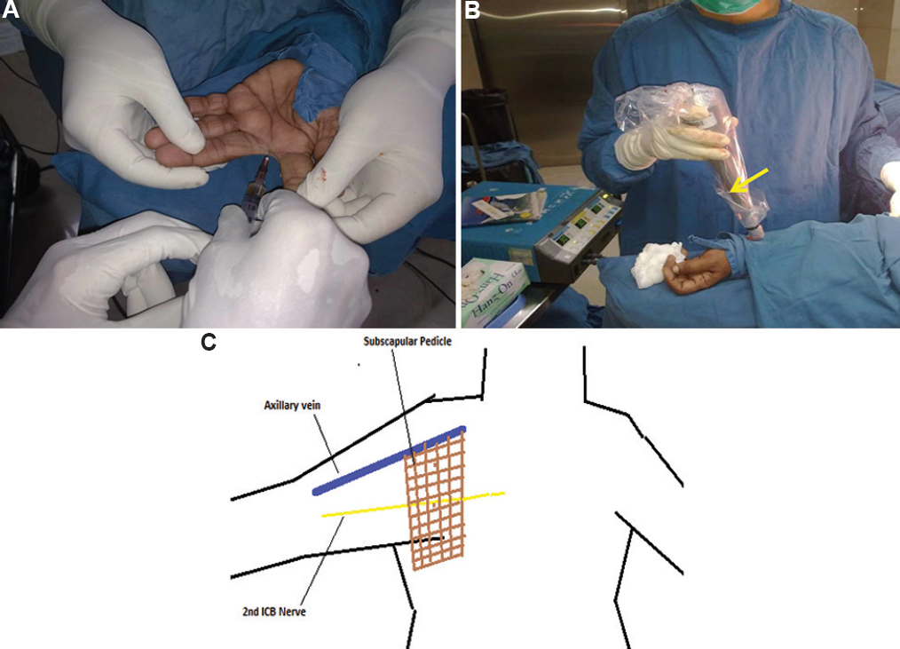 (A) Patient receiving filtered 99mTc sulphur colloid (37 mBq in 0.4 ml) injections in the 1st & 2nd interdigital webspace of the ipsilateral hand. 99mTc sulphur colloid travels through the superficial lymphatic channels of the upper limb and lodges in the 1st draining lymph node. (B) Handheld sterile draped gamma probe (yellow arrow) was manually moved along the arm to trace the radioactive counts from superficial lymphatic channels in the forearm, upper arm till the axilla to locate the ARM node i.e., node draining the arm (node showed ten times more radioactive counts than the background). (C) Graphical illustration of axillary region illustrating the three possible locations of axillary reverse mapping node (i) above the 2nd intercostobrachial nerve, (ii) just below the axillary vein or (iii) lateral to the subscapular pedicle.